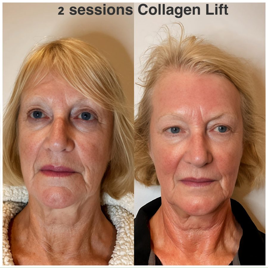 Client before and after two Collagen Lift sessions: jawline and neck firmer, jowls less pronounced.