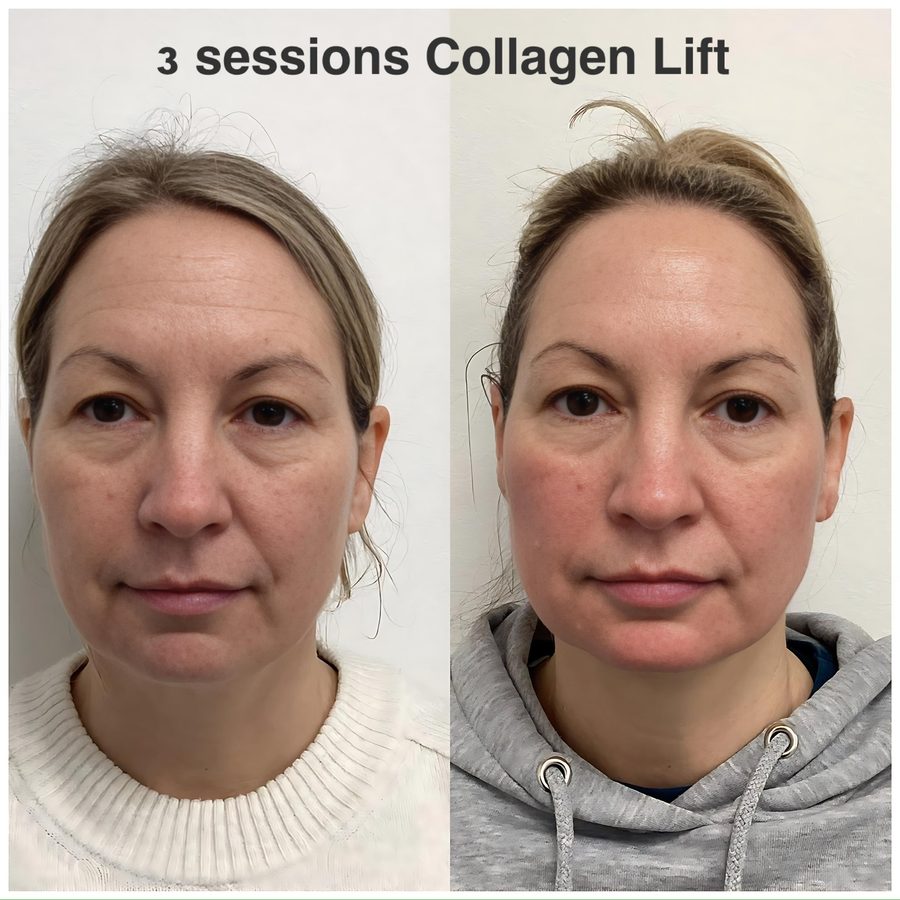 Client before and after three Collagen Lift sessions: cheeks lifted and the lower face more defined.