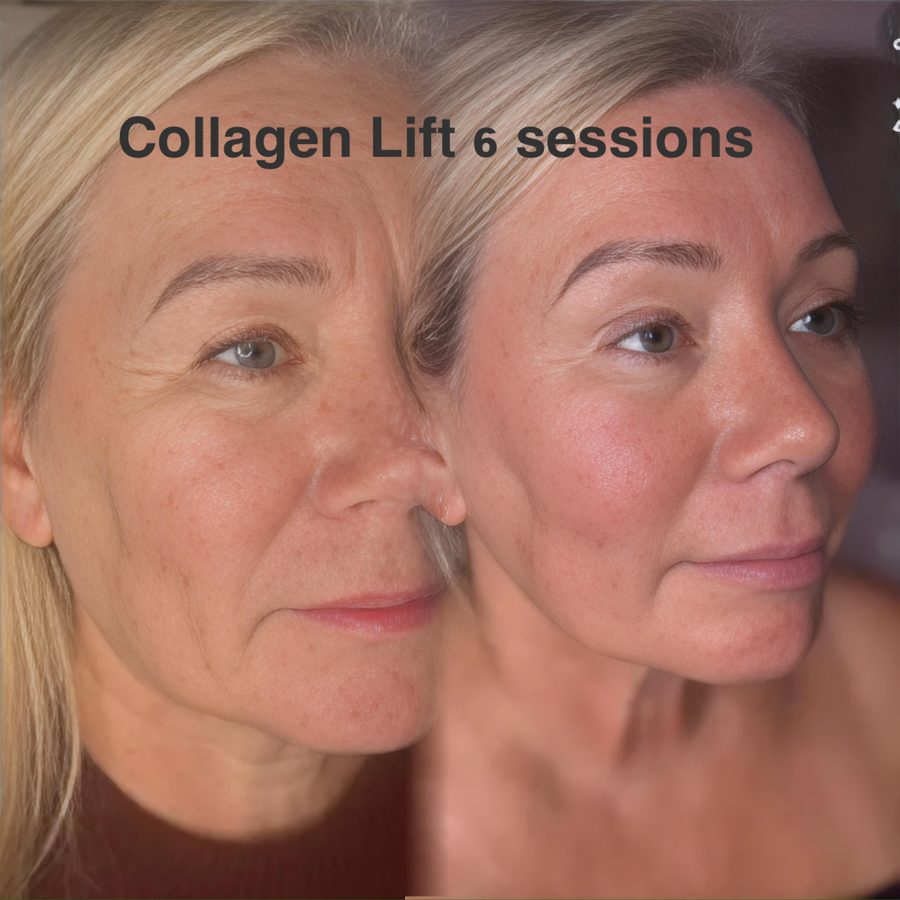 Client before and after six Collagen Lift sessions: lines around the eye and cheek softened, skin firmer.