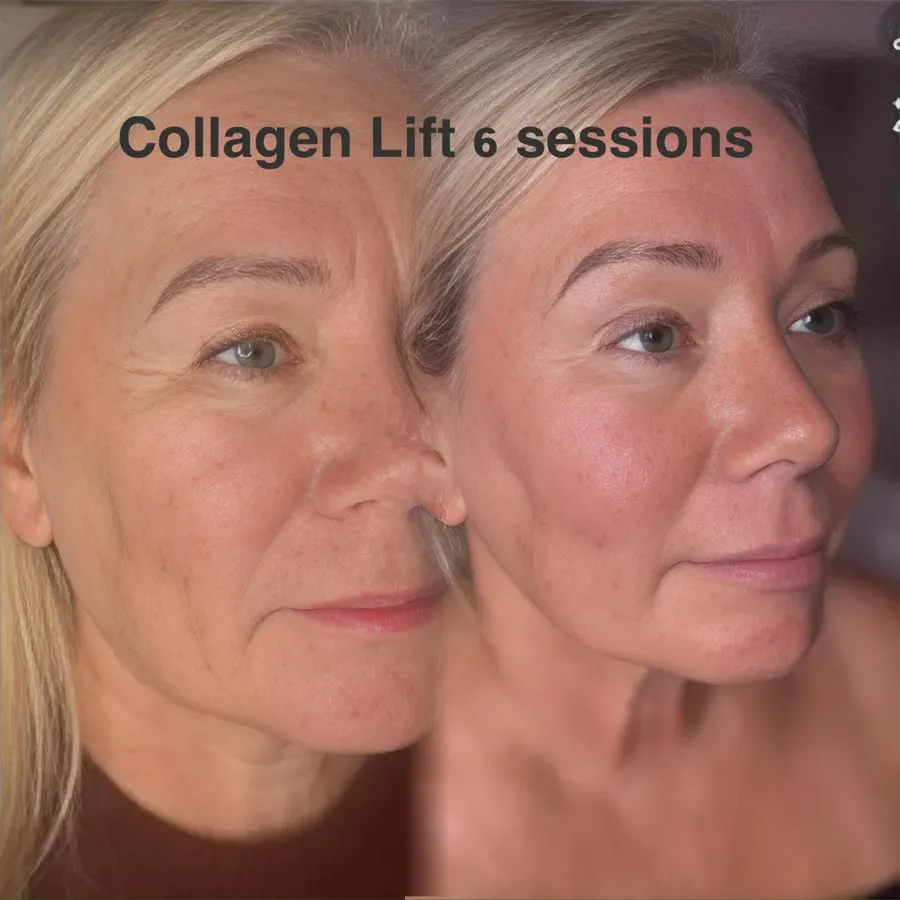 Client before and after six Collagen Lift sessions: lines around the eye and cheek softened, skin firmer.