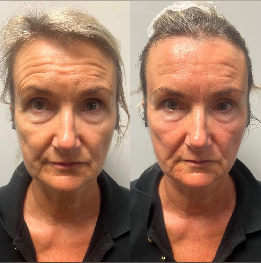 Client before and after one HIFU session and two RF Microneedling sessions: jawline and neck tighter, forehead smoother.
