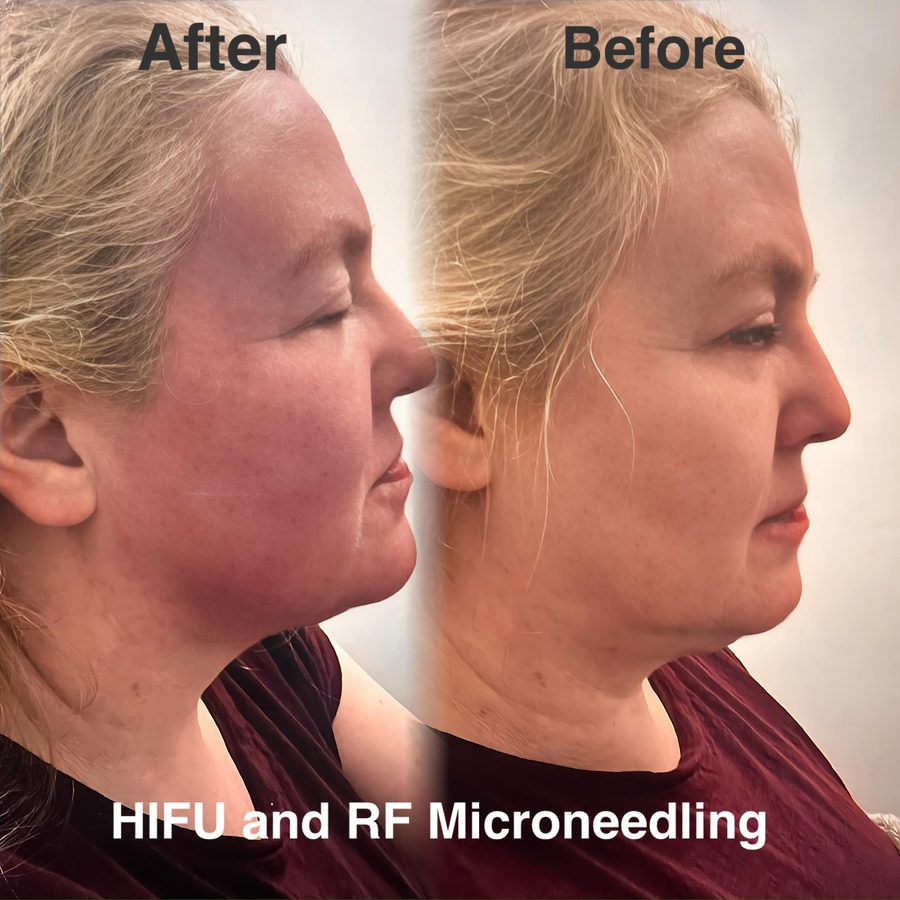 Client before and after HIFU combined with RF Microneedling: jawline and under-chin noticeably tighter in profile.
