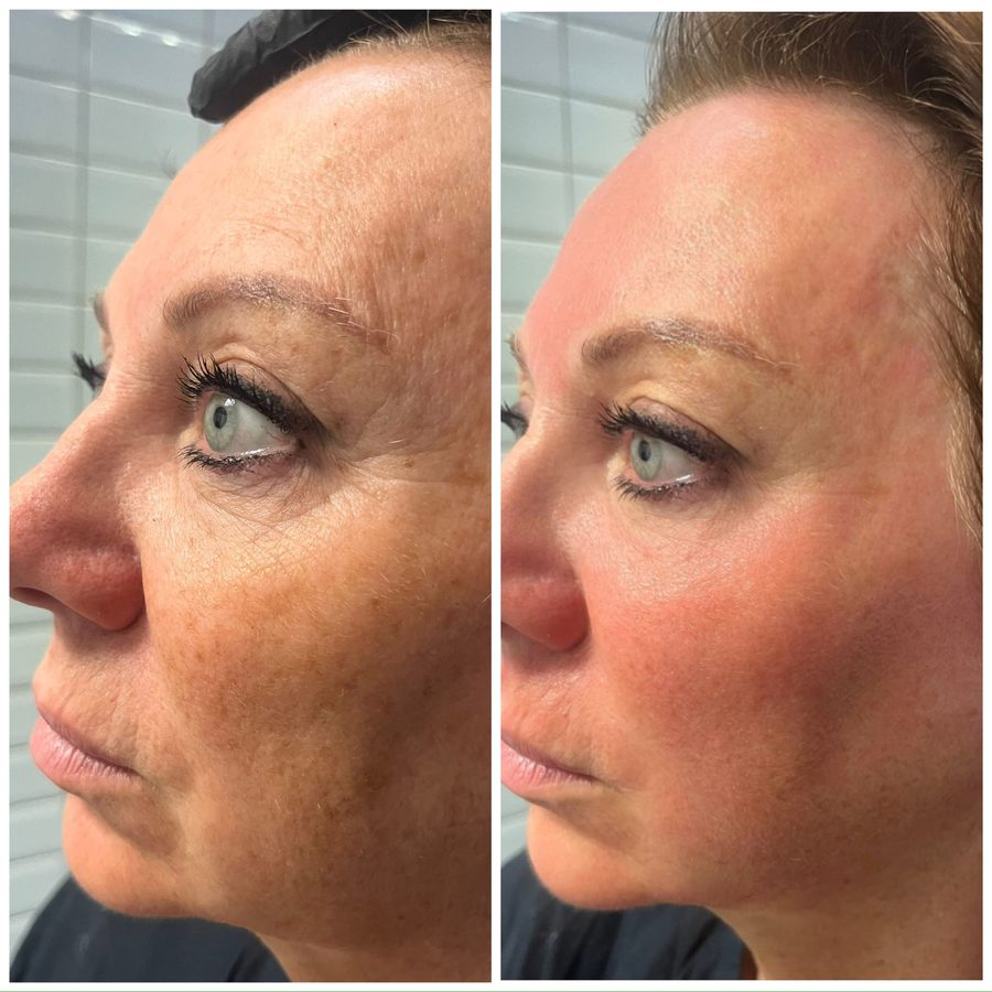 Client before and after RF Microneedling in profile: pigmentation and fine lines around the eye and cheek reduced.