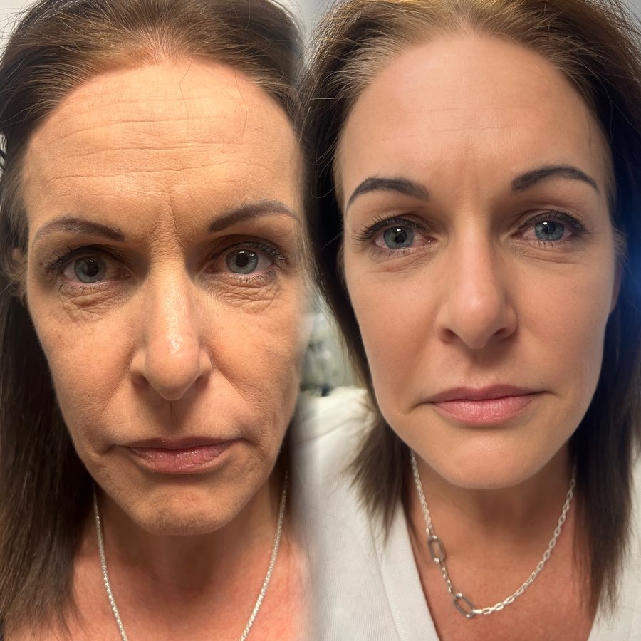 Client before and after three sessions of RF Microneedling: forehead lines and nasolabial folds softened, skin smoother overall.